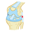 Torn LCL Injury - Grade 1
