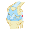 Torn LCL Injury - Grade 2