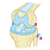Torn LCL Injury - Grade 3