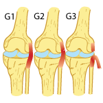Recovery Times for an LCL Tear Recovery Times for an LCL Tear