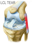 Torn LCL Injury Torn LCL Injury