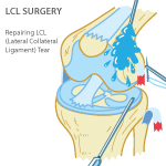 LCL Repair LCL Repair